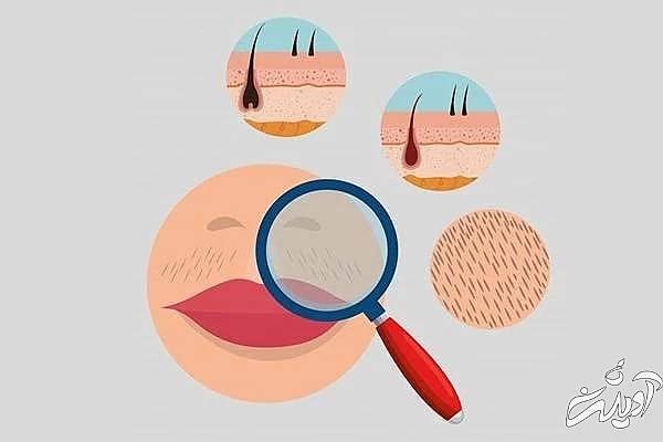 لیزر موهای صورت لیزر موهای زائد صورت
